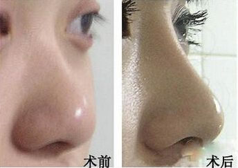 韩式隆鼻的效果怎么样