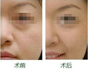 怎么消除黑眼圈好