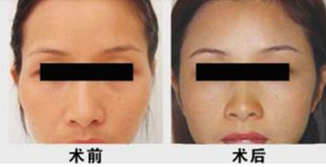 颞部填充