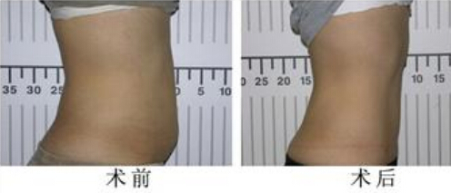 成都做腰腹吸脂费用多少