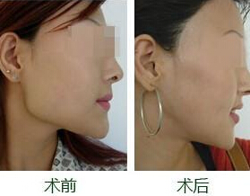 下颌角整形为什么无痕