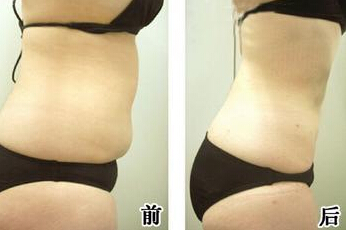 抽脂减肥效果持久不