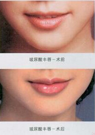 成都嘴巴整形有哪些