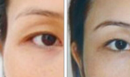 怎么填充太阳穴好