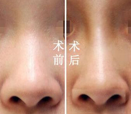 鼻翼塌陷怎么办才好
