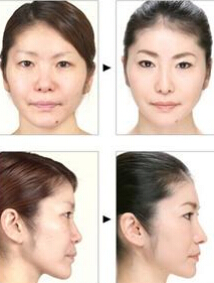 非手术隆鼻的效果好吗