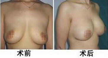 产后乳房下垂矫正怎么做呢