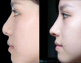 隆鼻后鼻头硬怎么办