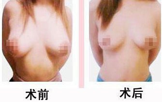 缩胸手术究竟如何