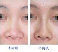 膨体隆鼻后会不会不自然