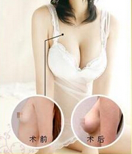 春天如何让乳房变大