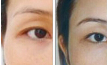 自体脂肪填充太阳穴