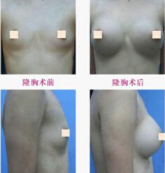 自体脂肪干细胞丰胸