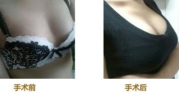 自体脂肪细胞丰胸