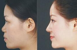 鼻梁垫高能增加财运吗