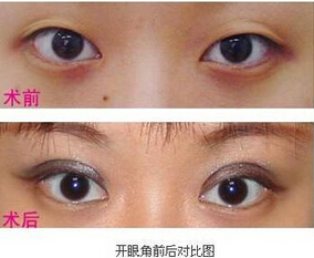 开眼角会显脸大吗