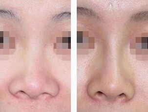 玻尿酸隆鼻多少钱一针