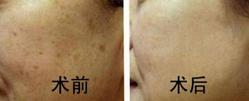 成美激光祛斑效果怎么样