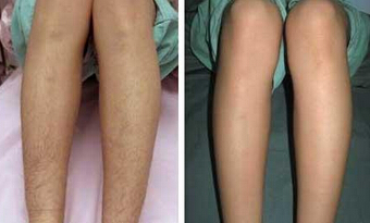 女生如何脱腿毛
