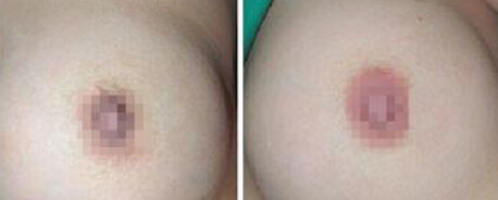 产后怎么让乳晕变成粉红色