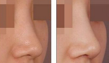 硅胶假体隆鼻后如何护理