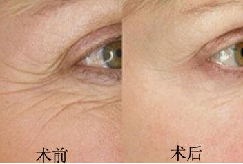 电波拉皮除皱对肌肤有伤害吗