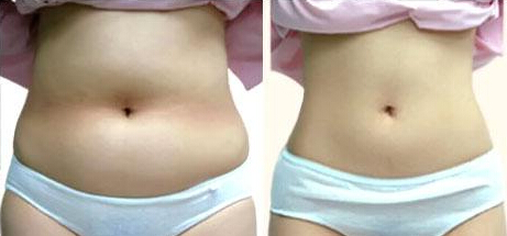腹部抽脂减肥术有没有危险