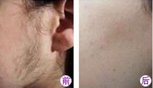 脸上汗毛重该怎么办
