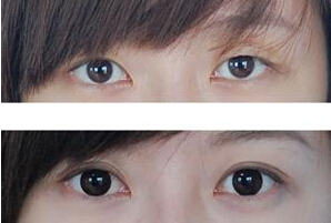女人眼皮松弛下垂怎样矫正
