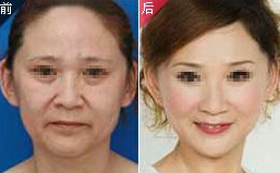 除皱针真能去皱吗