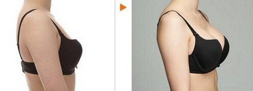 假体丰胸失败了怎么办
