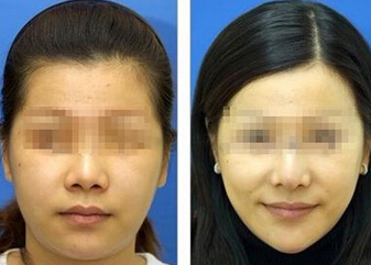 达州吸脂瘦脸多少钱