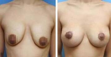 乳晕缩小术疤痕明显吗