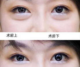 如何去掉眼袋