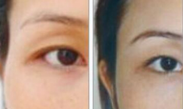 面部脂肪填充造就精致面孔