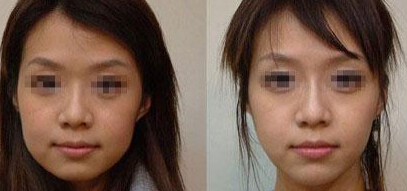 绵阳打瘦脸针多少钱