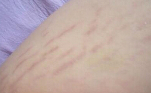 肥胖纹怎么办才好呢