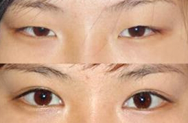 仿生重睑法好吗