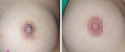 生育后乳晕发黑怎么回事