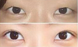开眼角手术失败后该怎么修复