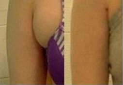 腋下长副乳如何消除