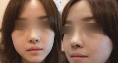 怎么缩小鼻翼好呢