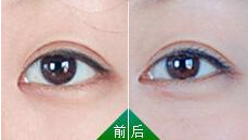 怎么矫正三角眼好