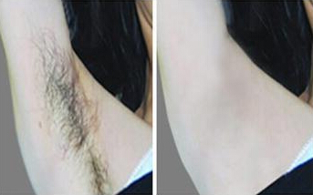 身上毛多怎么办才好呢