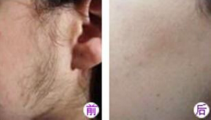 女生脸上毛多怎么办