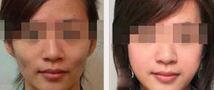 面部凹陷填充有哪些方式