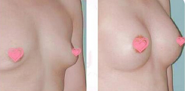 丰胸整形让你做自信美丽的女人