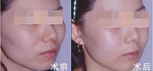 颧骨一高一低怎么办才好
