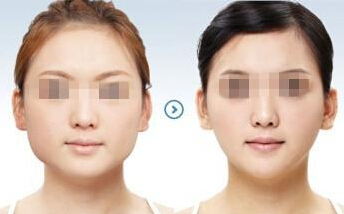 面部吸脂后多久能化妆