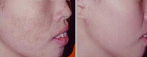 激光祛斑有用吗?